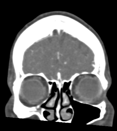 Basilar tip aneurysm with coiling (Radiopaedia 53912-60086 B 16).jpg