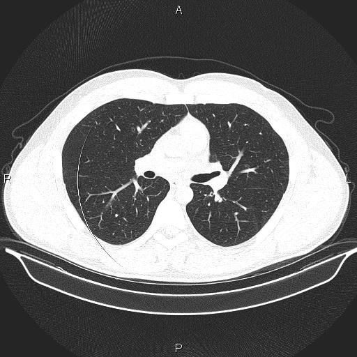 Beam hardening and ring artifacts (Radiopaedia 85323-100915 Axial lung window 36).jpg