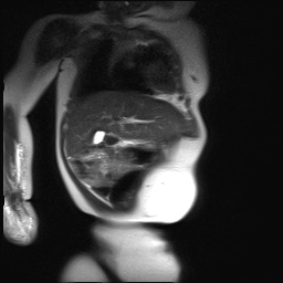 File:Beckwith-Wiedeman syndrome with bilateral Wilms tumors (Radiopaedia 60850-69233 B 22).jpg
