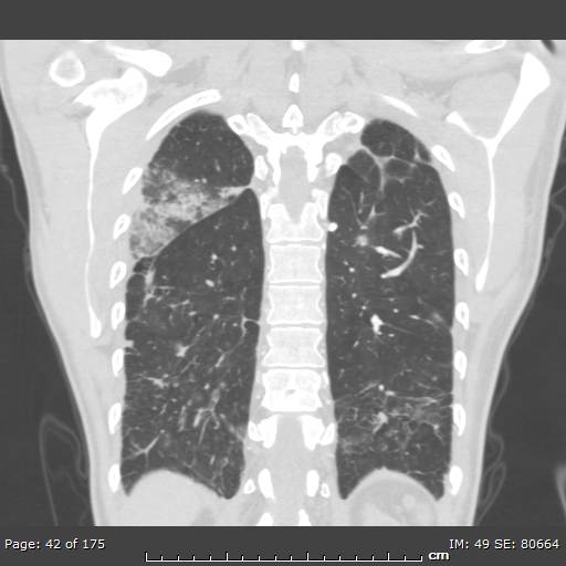 File:Behçet disease (Radiopaedia 44247-47889 Coronal lung window 9).jpg