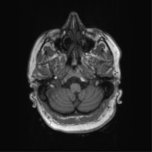 Behavioral variant frontotemporal dementia and late onset schizophrenia (Radiopaedia 52197-58083 Axial T1 97).png