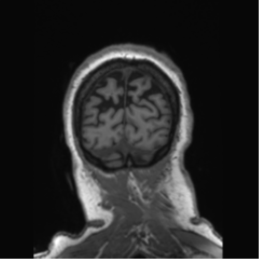 Behavioral variant frontotemporal dementia and late onset schizophrenia (Radiopaedia 52197-58083 Coronal T1 18).png