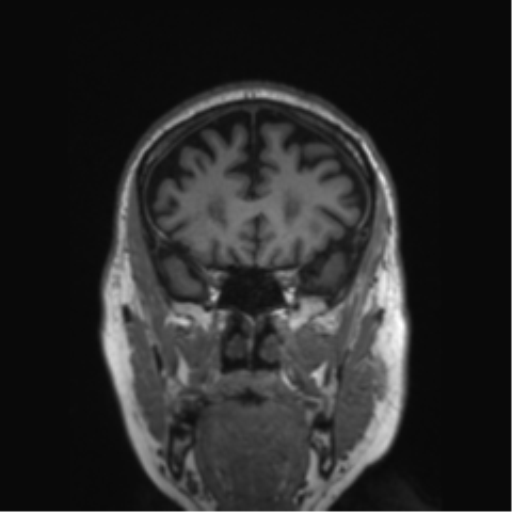 Behavioral variant frontotemporal dementia and late onset schizophrenia (Radiopaedia 52197-58083 Coronal T1 67).png