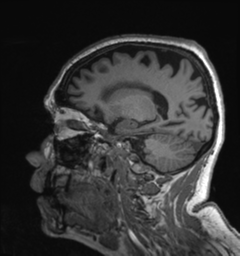 Behavioral variant frontotemporal dementia and late onset schizophrenia (Radiopaedia 52197-58083 Sagittal T1 30).png