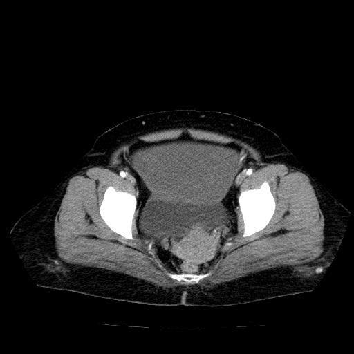 Benign spindle cell tumor - abdominopelvic (Radiopaedia 61300-69212 A 54).jpg
