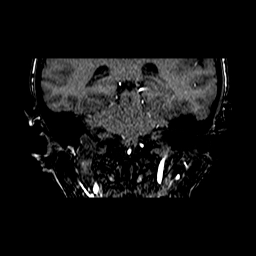 File:Berry aneurysm of the terminal internal carotid artery (Radiopaedia 88286-104918 Coronal TOF 68).jpg