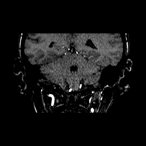 Berry aneurysm of the terminal internal carotid artery (Radiopaedia 88286-104918 Coronal TOF 76).jpg