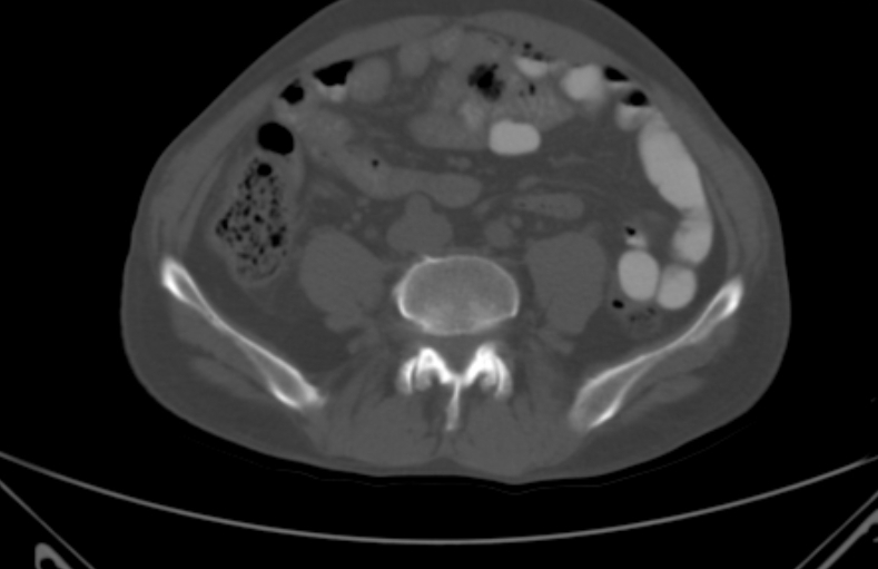 File:Bertolotti syndrome (Radiopaedia 58974-66235 Axial bone window 17).jpg