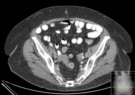 Bicameral celiacomesenteric aneurysm (Radiopaedia 55766-62327 A 56).jpg