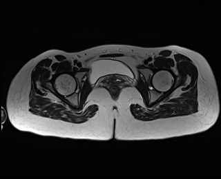 File:Bicornuate bicollis uterus (Radiopaedia 61626-69616 Axial T2 31).jpg