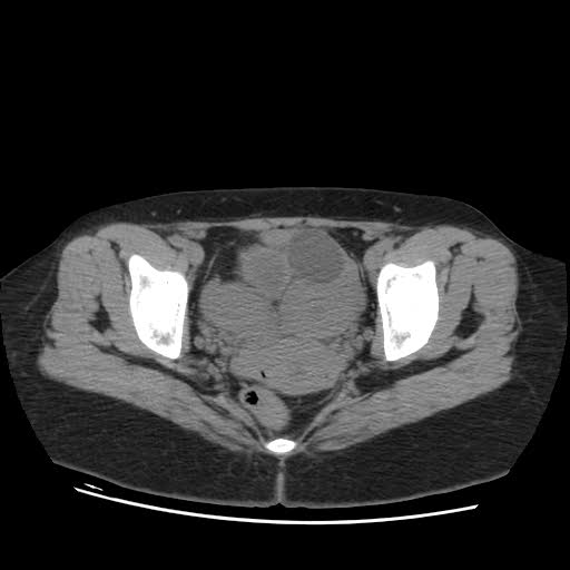 File:Bicornuate uterus (MRI) (Radiopaedia 49206-54296 Axial 3).jpg