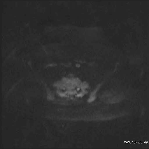 File:Bicornuate uterus (MRI) (Radiopaedia 49206-54297 Axial 110).jpg