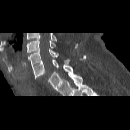File:Bilateral C6-7 locked facet dislocation (Radiopaedia 28506-28748 Sagittal bone window 8).jpeg