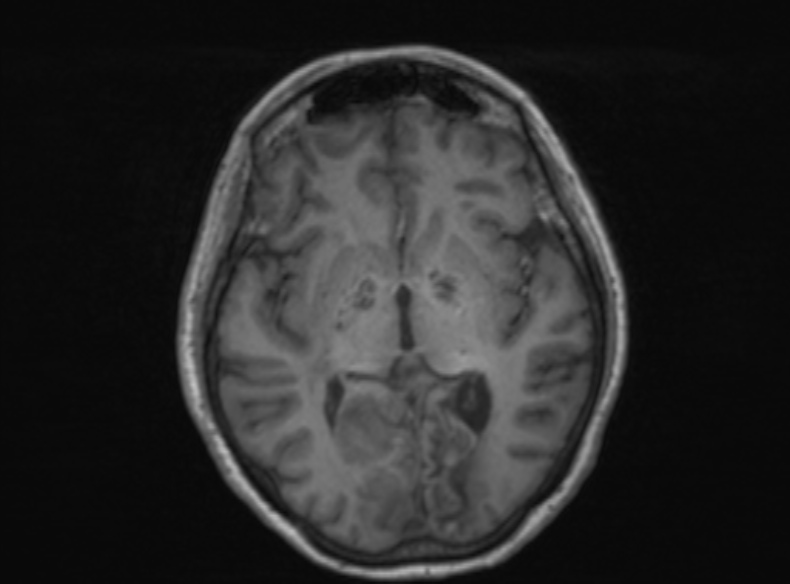 Bilateral PCA territory infarction - different ages (Radiopaedia 46200-51784 Axial T1 242).jpg