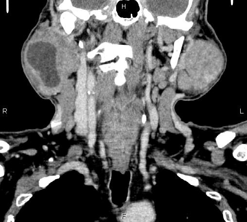 File:Bilateral Warthin tumors (Radiopaedia 84034-99263 C 27).jpg