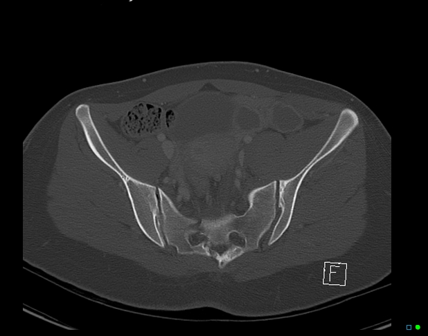 Bilateral acetabular fractures (Radiopaedia 79272-92308 Axial bone window 24).jpg