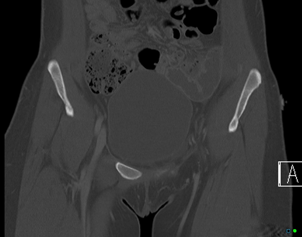 File:Bilateral acetabular fractures (Radiopaedia 79272-92308 Coronal bone window 5).jpg