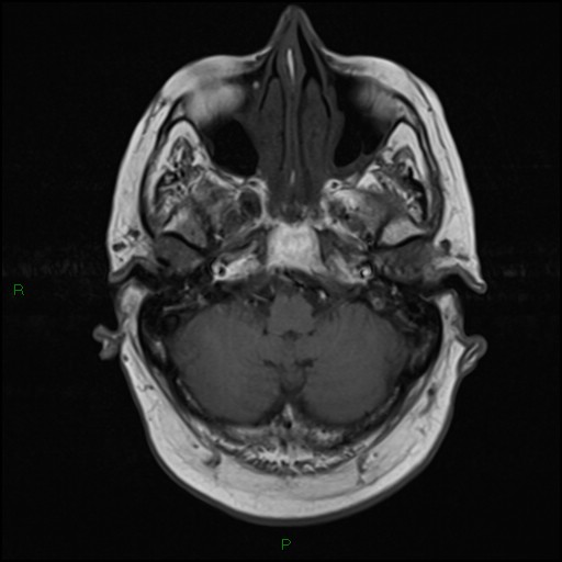 File:Bilateral acute middle cerebral artery territory infarcts (Radiopaedia 77319-89402 Axial T1 5).jpg