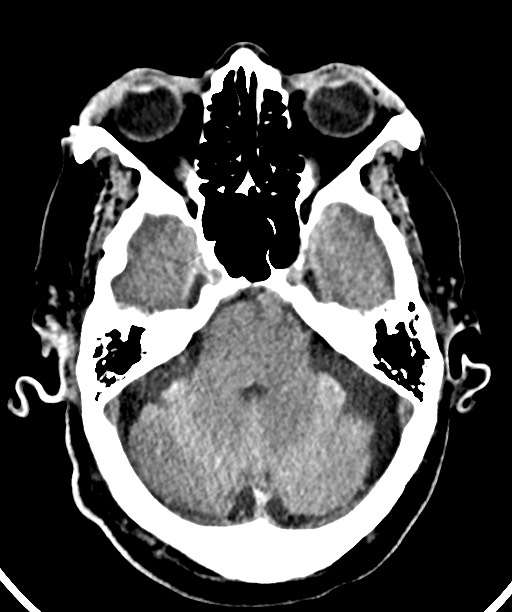 Bilateral acute on chronic subdural hematomas (Radiopaedia 78466-91146 Axial non-contrast 19).jpg