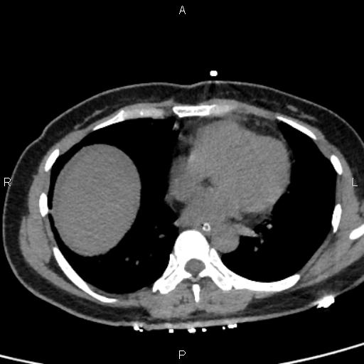 Bilateral adrenal gland hyperenhancement in pancreatitis (Radiopaedia 86642-102753 Axial non-contrast 2).jpg