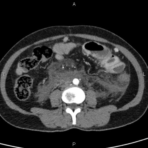 Bilateral adrenal gland hyperenhancement in pancreatitis (Radiopaedia 86642-102753 B 80).jpg