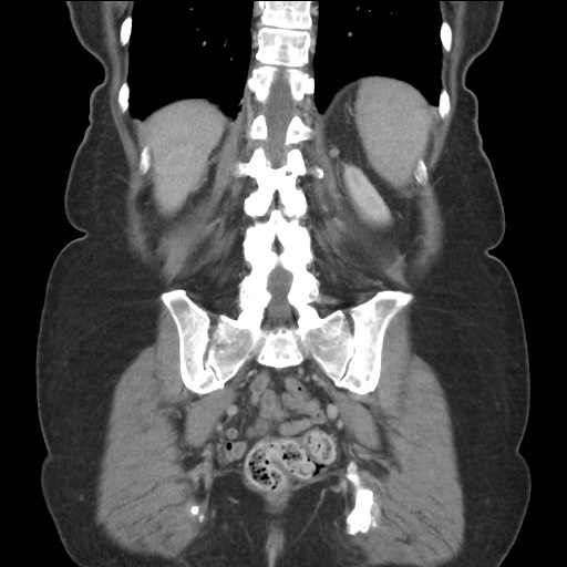 Bilateral adrenal granulocytic sarcomas (chloromas) (Radiopaedia 78375-91007 B 71).jpg