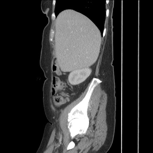 Bilateral adrenal granulocytic sarcomas (chloromas) (Radiopaedia 78375-91007 C 41).jpg