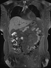 Bilateral adrenal myelolipoma (Radiopaedia 63058-71537 Coronal T1 fat sat 76).jpg
