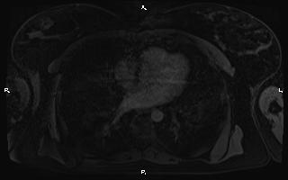 Bilateral adrenal myelolipoma (Radiopaedia 63058-71537 G 1).jpg