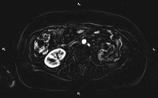 Bilateral adrenal myelolipoma (Radiopaedia 63058-71537 I 59).jpg