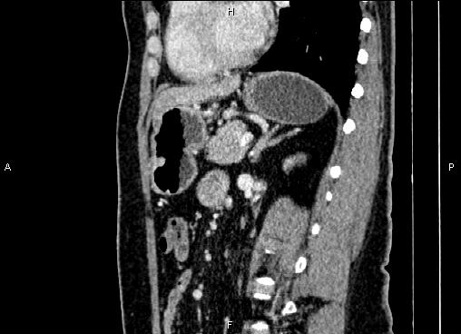 Bilateral benign adrenal adenomas (Radiopaedia 86912-103124 E 61).jpg