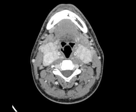 File:Bilateral carotid body tumors (Radiopaedia 61841-69870 Axial Post contrast 49).jpg