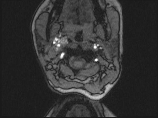 Bilateral carotid body tumors and right glomus jugulare tumor (Radiopaedia 20024-20060 Axial MRA 275).jpg