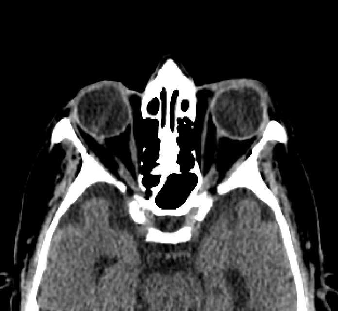 Bilateral ectopia lentis (Radiopaedia 89889-107013 Axial non-contrast 39).jpg