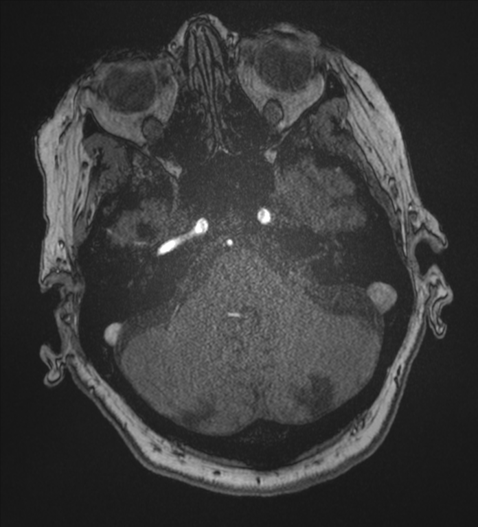 Bilateral fetal posterior communicating arteries (Radiopaedia 41286-44102 Axial MRA 39).png