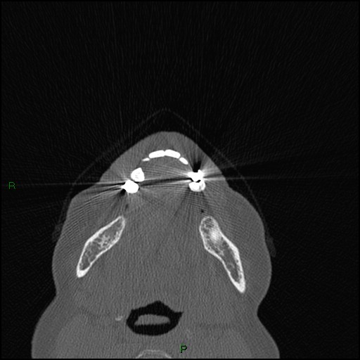 Bilateral frontal mucoceles (Radiopaedia 82352-96454 Axial bone window 297).jpg