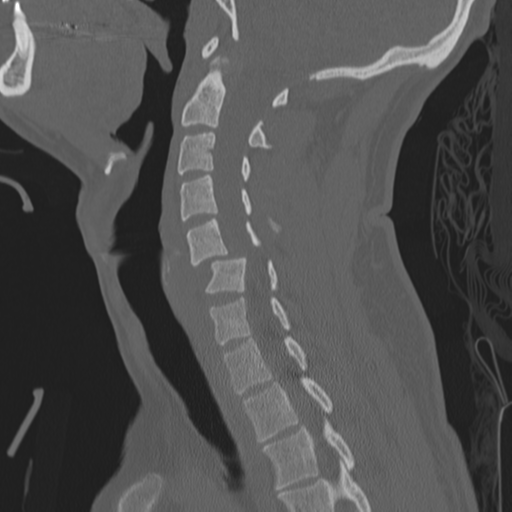 Bilateral locked facets (Radiopaedia 33850-35016 Sagittal bone window 19).png