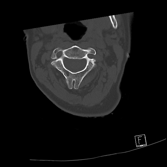 Bilateral occipital condyle fractures (type 3) (Radiopaedia 87672-104086 Axial bone window 25).jpg