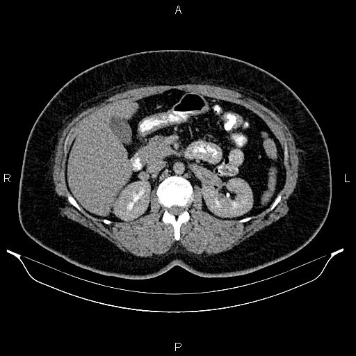 Bilateral ovarian dermoid cysts (Radiopaedia 85785-101603 Axial C+ delayed 24).jpg