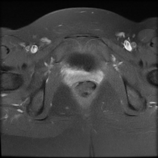File:Bilateral ovarian fibrothecomas - adolescent (Radiopaedia 86604-102707 Axial T1 C+ fat sat 26).jpg