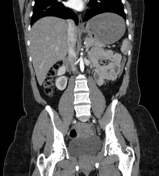 Bilateral ovarian mature cystic teratomas (Radiopaedia 79373-92457 B 40).jpg