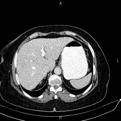 Bilateral ovarian serous cystadenocarcinoma (Radiopaedia 86062-101989 B 21).jpg