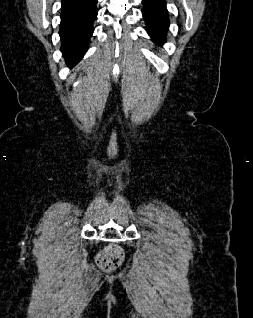 Bilateral ovarian serous cystadenocarcinoma (Radiopaedia 86062-101989 D 52).jpg