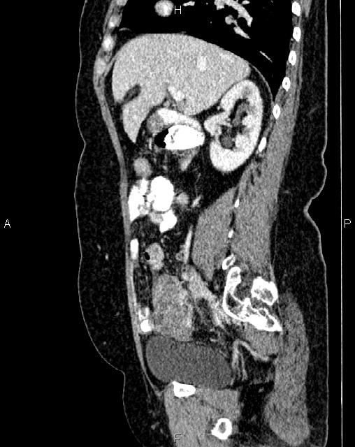 Bilateral ovarian serous cystadenocarcinoma (Radiopaedia 86062-101989 E 28).jpg
