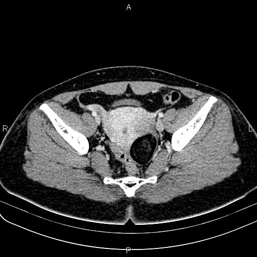 Bilateral ovarian teratoma (Radiopaedia 83131-97503 Axial With contrast 43).jpg