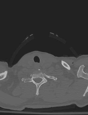 Bilateral perched facet joint (Radiopaedia 63149-71669 Axial bone window 59).jpg