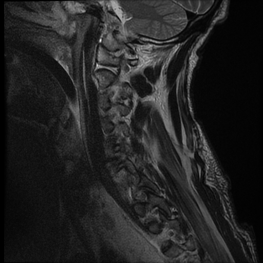 File:Bilateral perched facets with cord injury (Radiopaedia 45587-49714 Sagittal T2 13).jpg