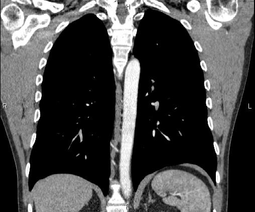 File:Bilateral pulmonary AVM (Radiopaedia 83134-97505 C 50).jpg