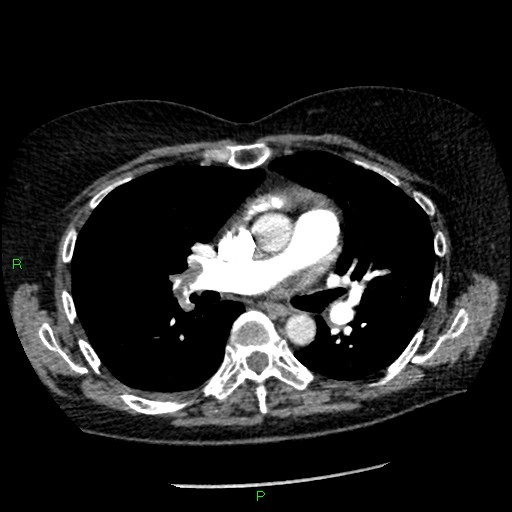 Bilateral pulmonary emboli (Radiopaedia 32700-33669 Axial C+ CTPA 51).jpg