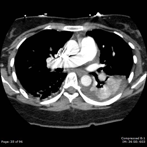 Bilateral pulmonary emboli with Hampton hump sign (Radiopaedia 54070-60246 Axial C+ CTPA 32).jpg